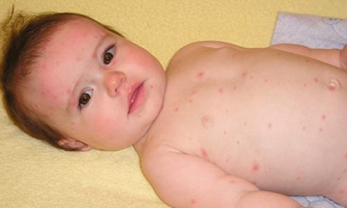 Bé bị nổi mẩn đỏ ở bụng và lưng và cách xử lí
